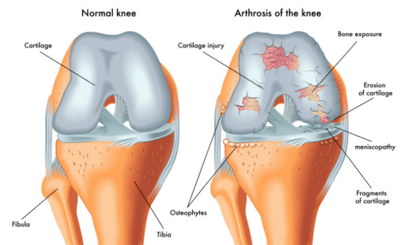 Articulation normale et affectée par l'arthrose