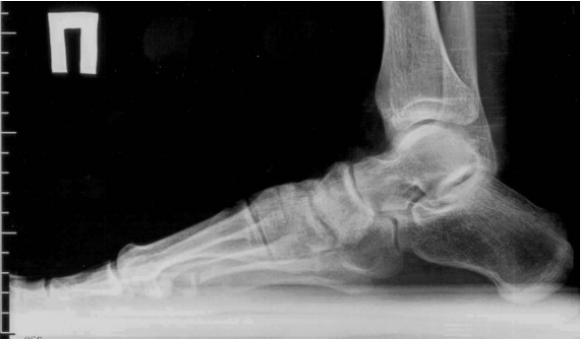 Fingers et pieds d'arthrose